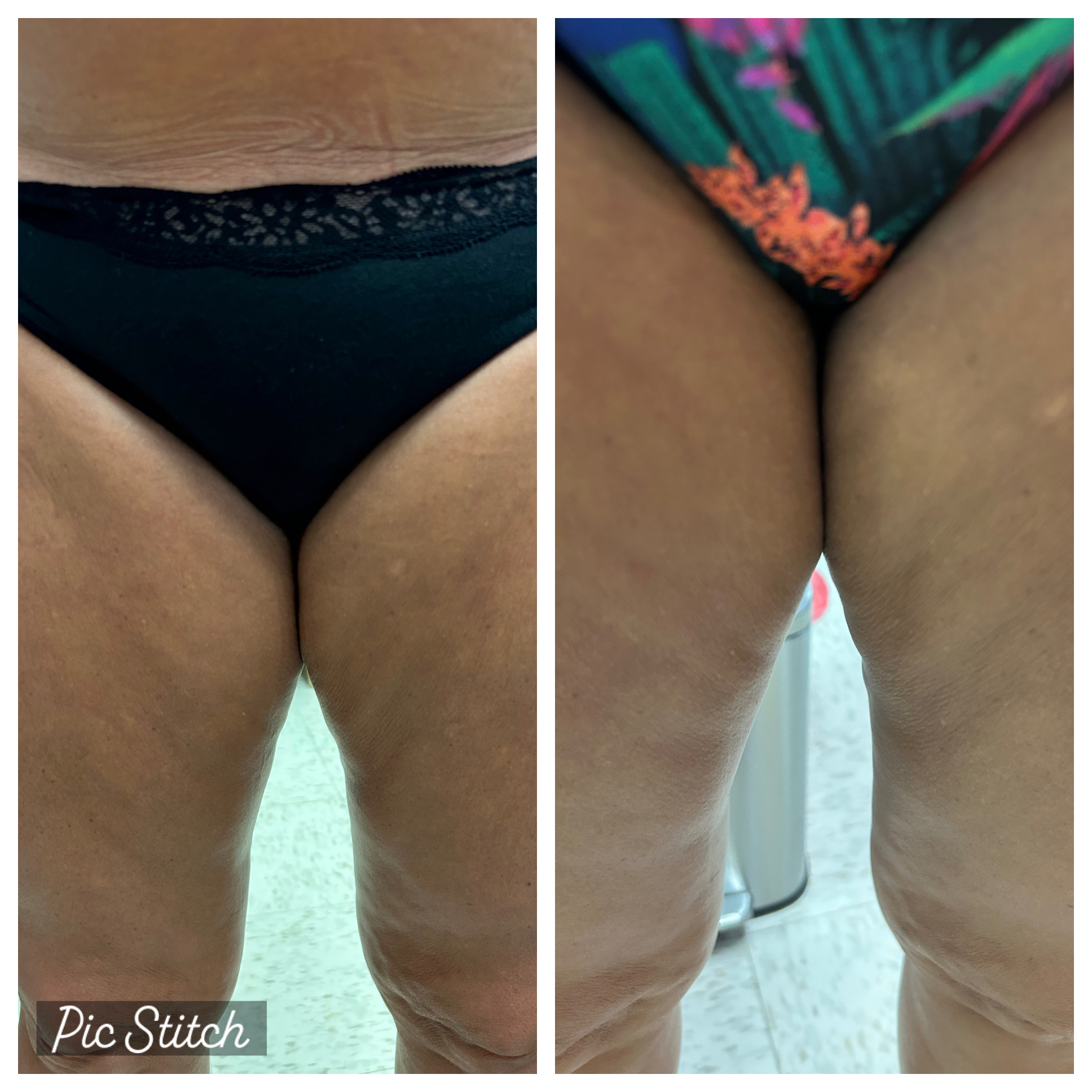 </p>
<p>Before and after photo of cellulite reduction using Morpheus8:<br />
