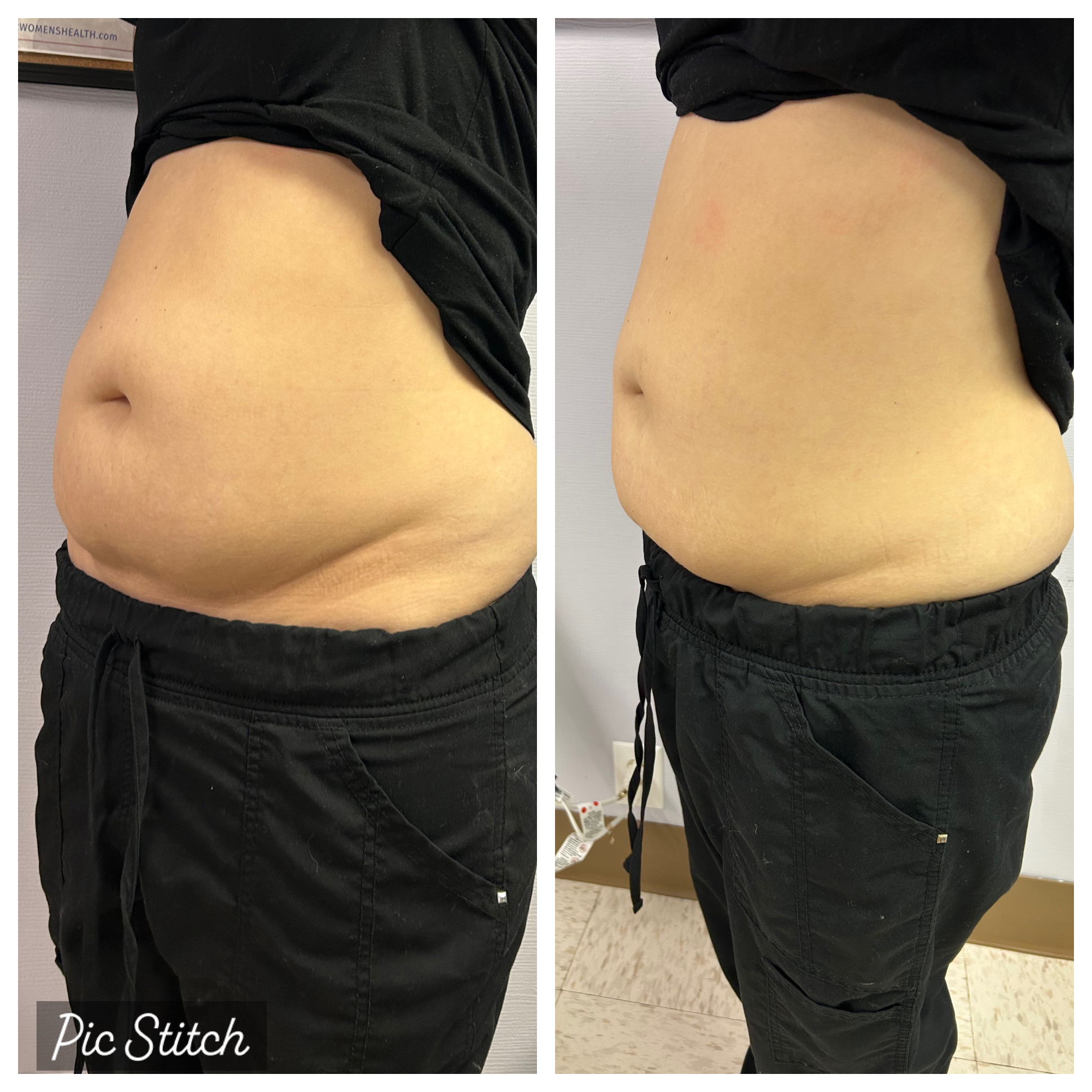 before and after photos of male belly reduction<br />

