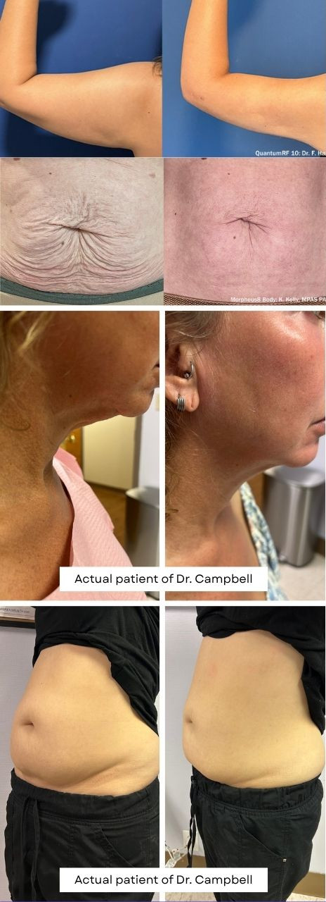 BEfore and after photos of QuantumRF<br />
