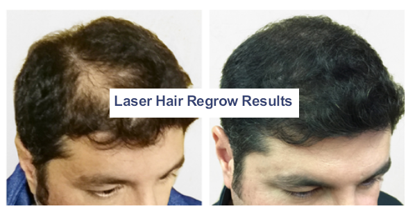 Before and After photos for Hair restoration treatments