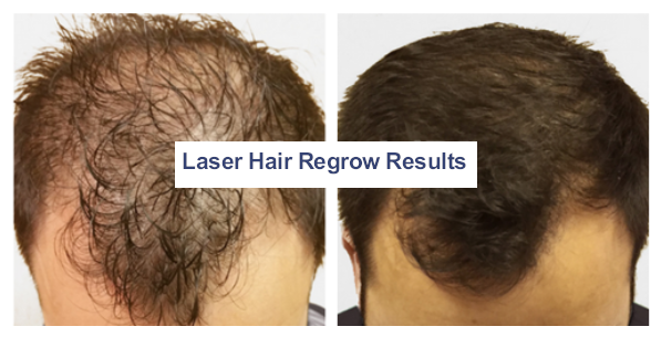 Before and After photos for Hair restoration treatments<br />
