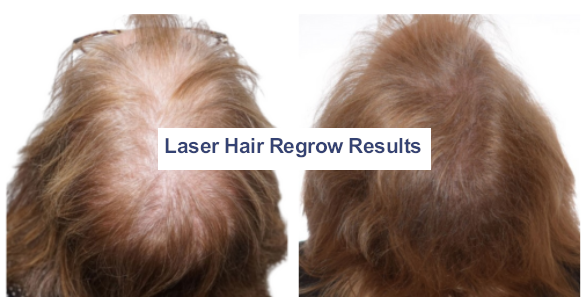Before and After photos for Hair restoration treatments<br />
