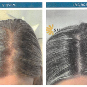 Before and after photos of hair restoration